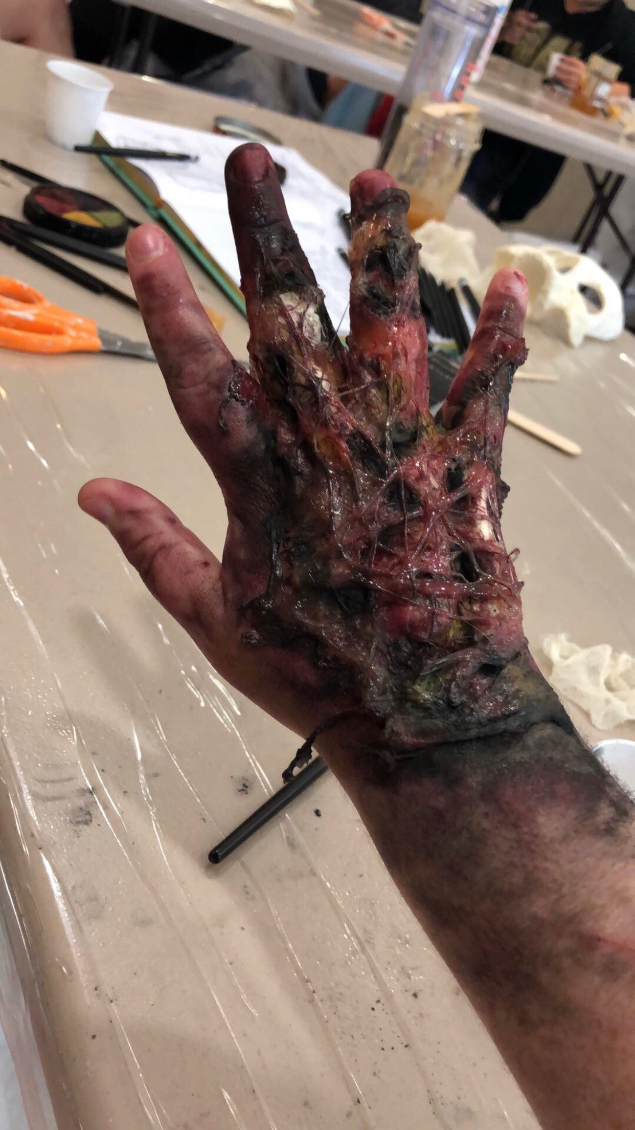 April 2019—3rd Degree Burns