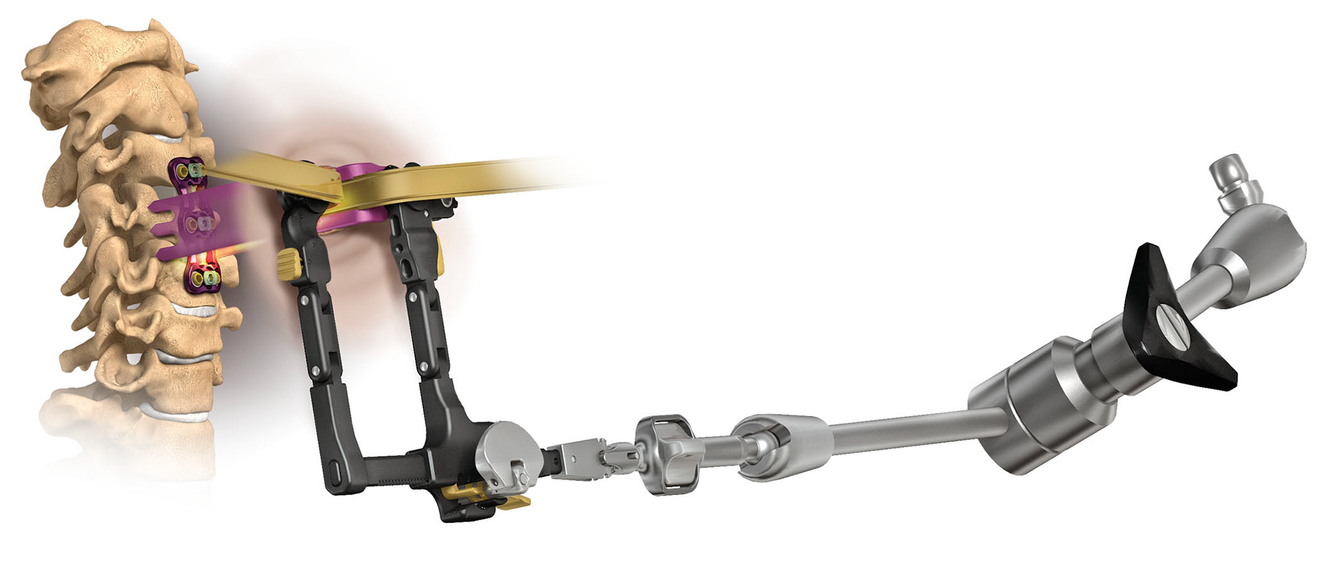 Medical illustration of cervical spinal fusion and plating.