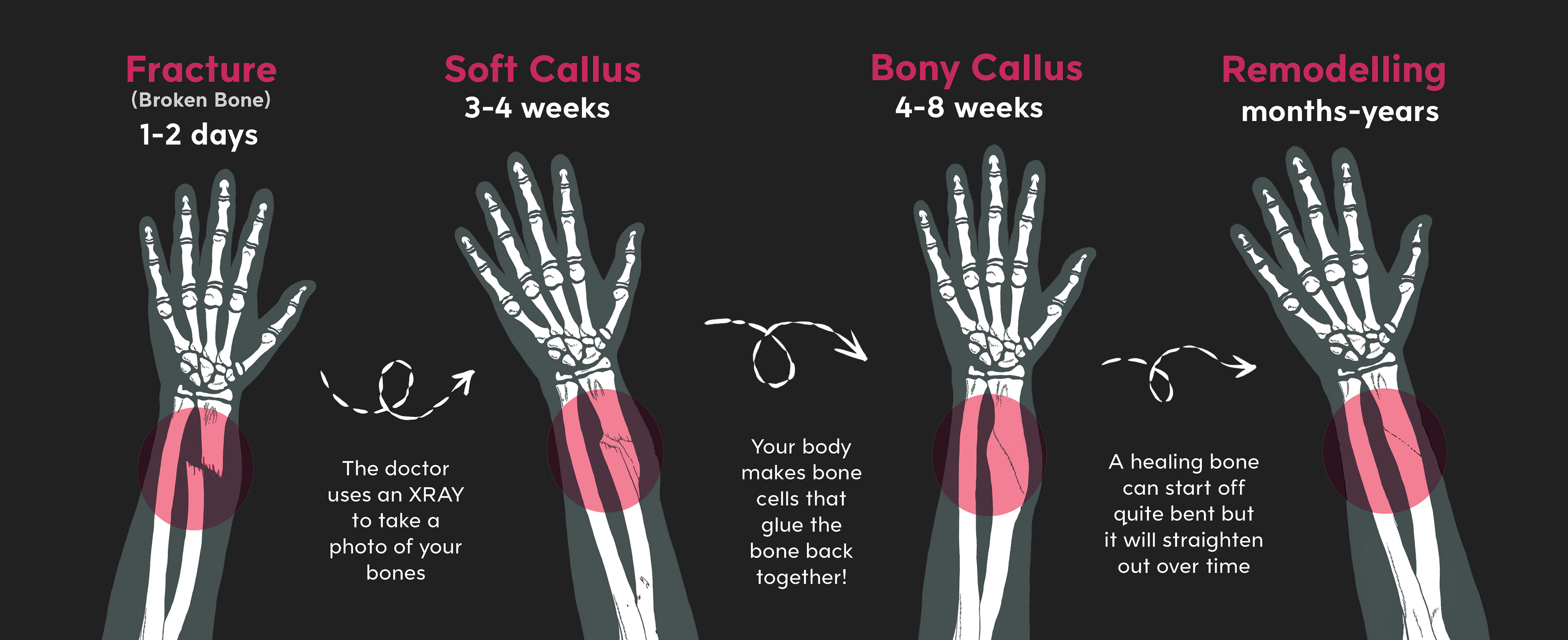 Stages Of Fracture Healing - Speeding Up Bone Fracture Healing part 2 ...