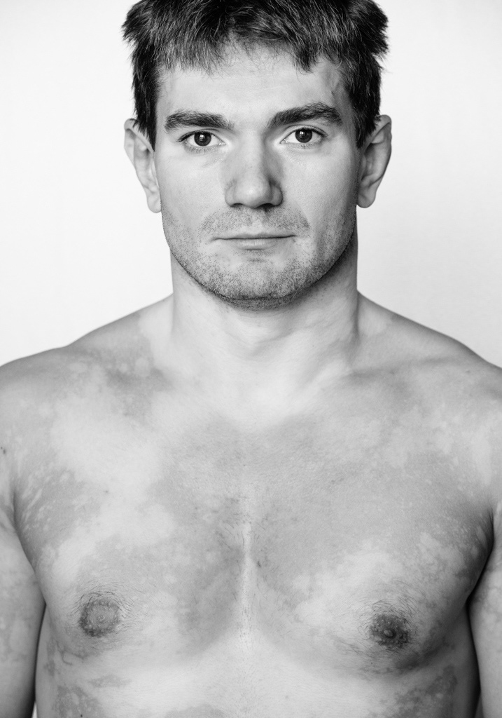 Back and white medium headshot. A male model is shirtless and stares intently towards the camera. He has a light skin tone with patches of vitiligo located intermittently across his torso like a sponge painting and creating a v-shape neckline.