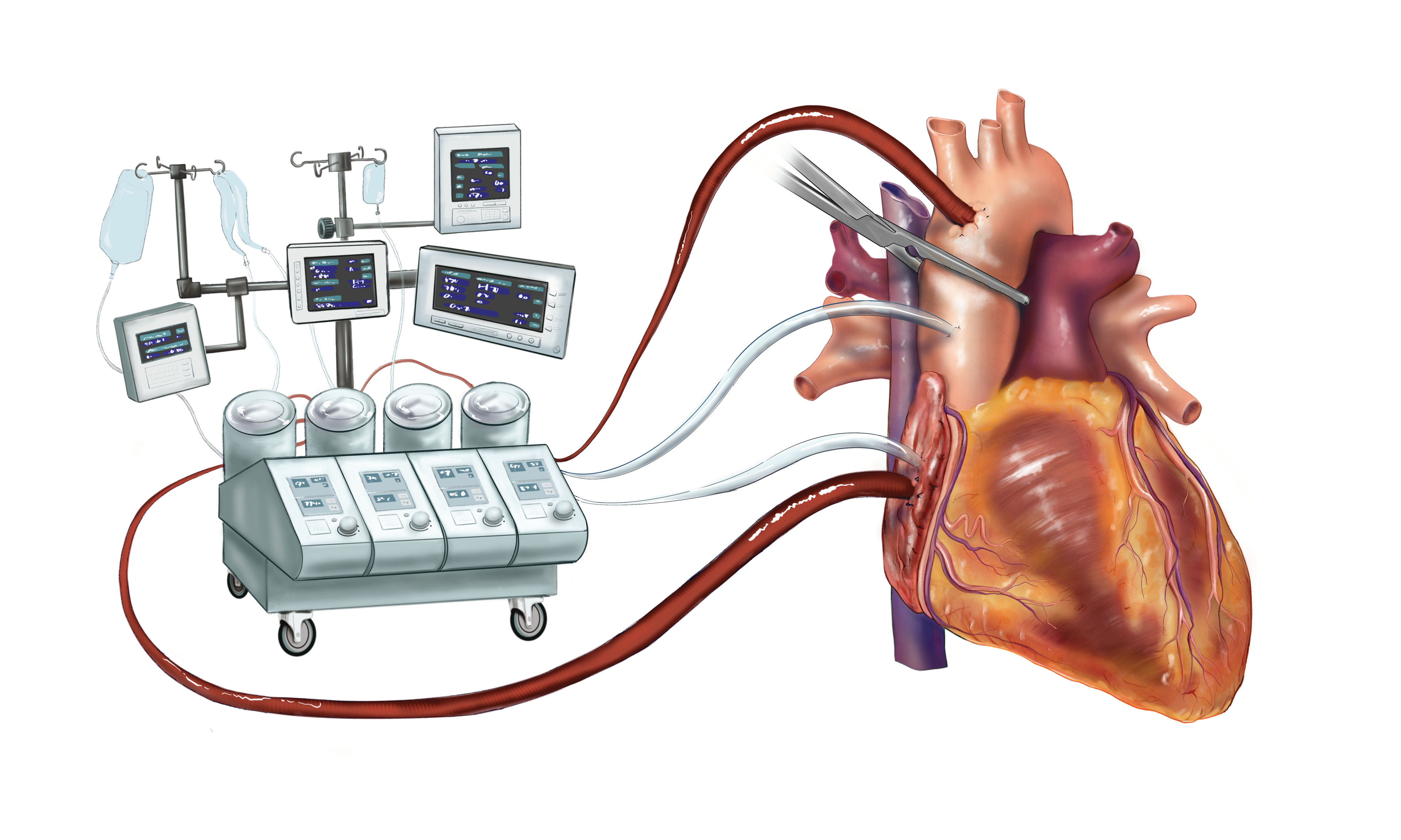 Cardio-pulmonary bypass