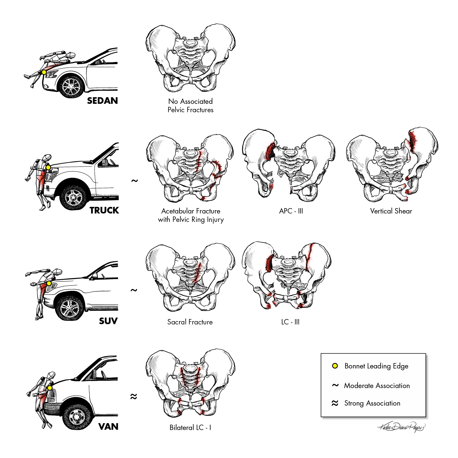 Pelvic Ring Injuries associated with vehicle body type and bonnet leading edge